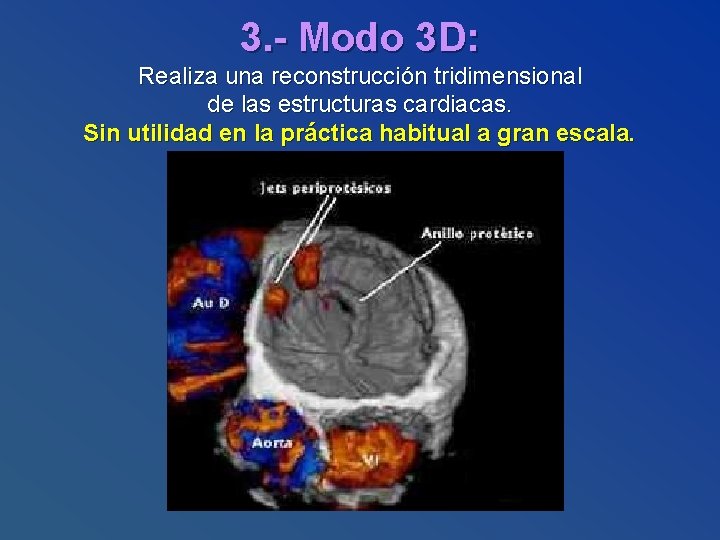 3. - Modo 3 D: Realiza una reconstrucción tridimensional de las estructuras cardiacas. Sin