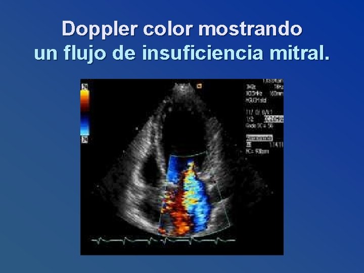 Doppler color mostrando un flujo de insuficiencia mitral. 