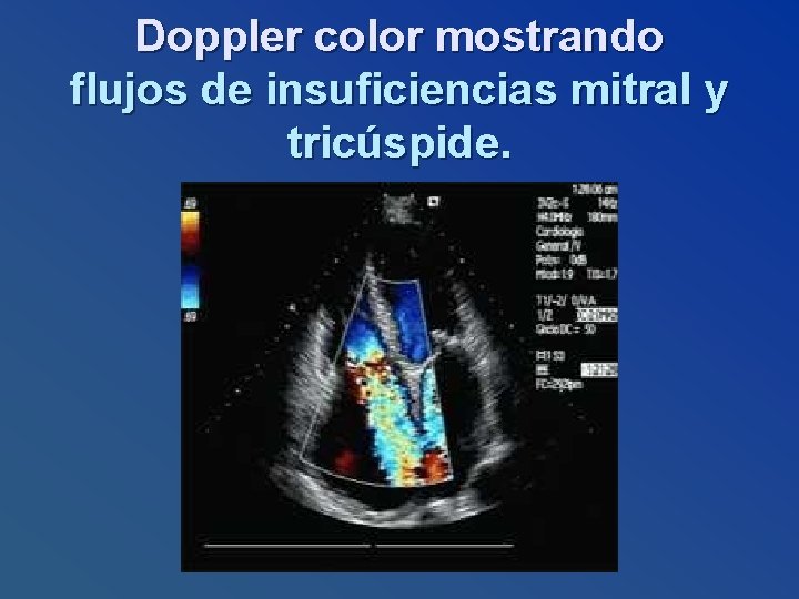 Doppler color mostrando flujos de insuficiencias mitral y tricúspide. 