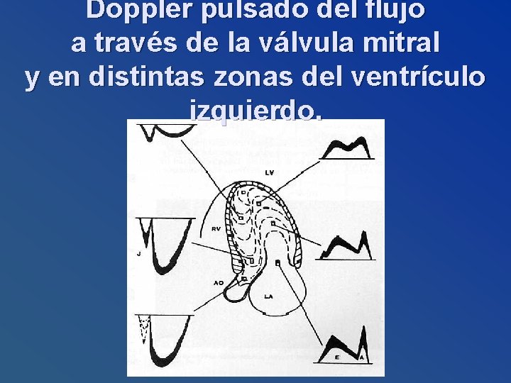 Doppler pulsado del flujo a través de la válvula mitral y en distintas zonas