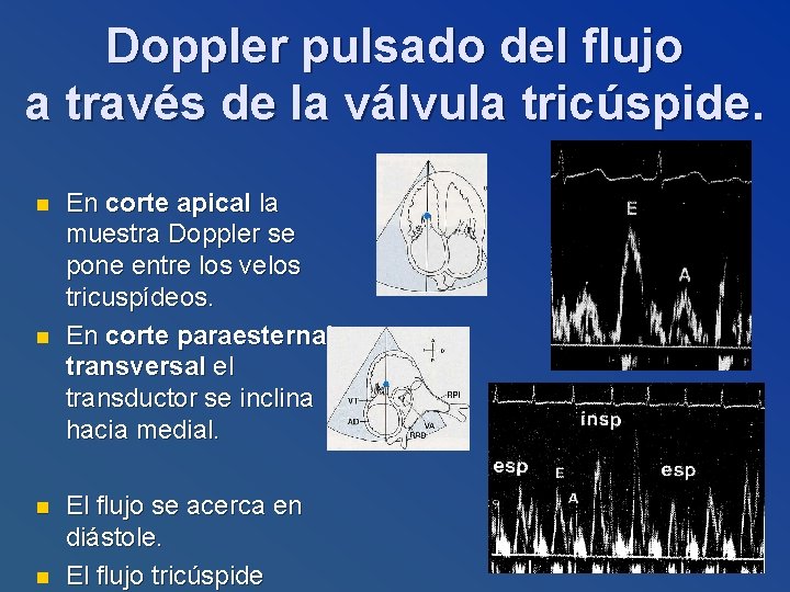 Doppler pulsado del flujo a través de la válvula tricúspide. n n En corte
