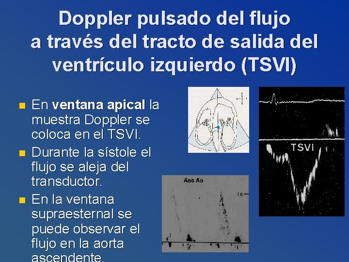 Doppler pulsado del flujo a través del tracto de salida del ventrículo izquierdo (TSVI)