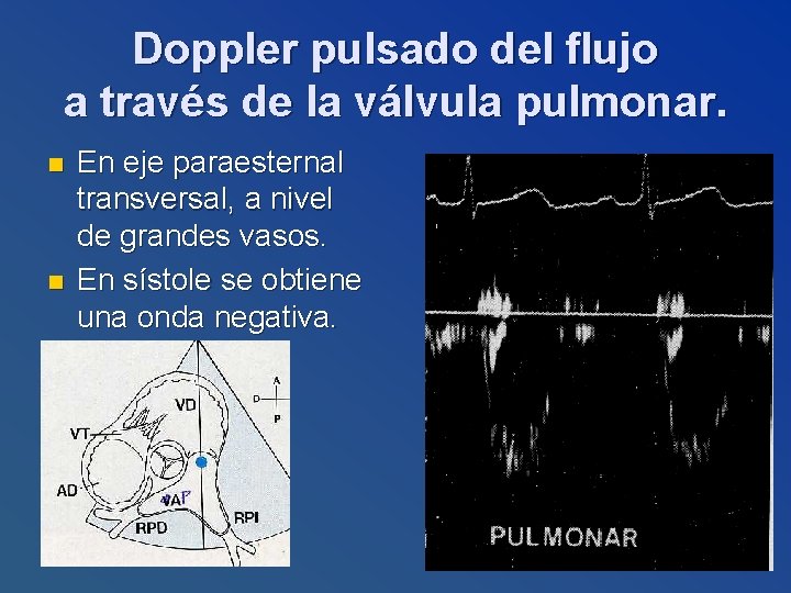 Doppler pulsado del flujo a través de la válvula pulmonar. n n En eje