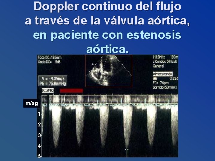 Doppler continuo del flujo a través de la válvula aórtica, en paciente con estenosis