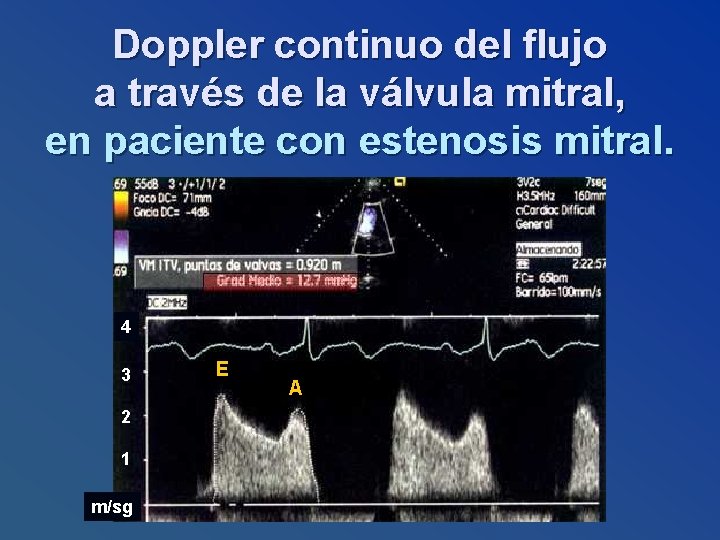 Doppler continuo del flujo a través de la válvula mitral, en paciente con estenosis