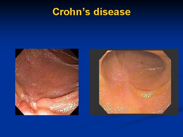 Crohn’s disease 