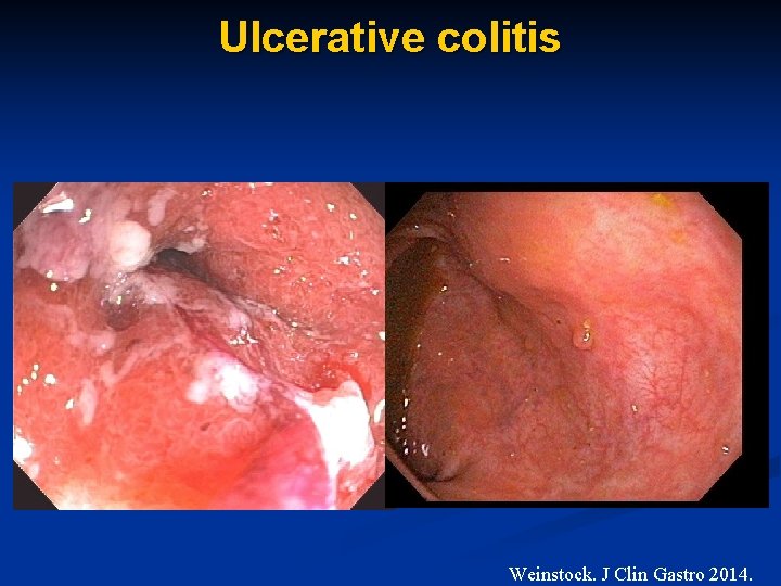 Ulcerative colitis Weinstock. J Clin Gastro 2014. 