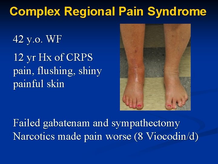 Complex Regional Pain Syndrome 42 y. o. WF 12 yr Hx of CRPS pain,