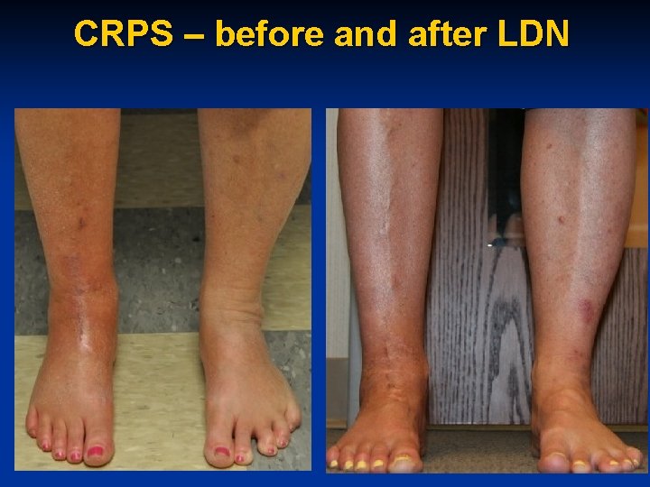 CRPS – before and after LDN 