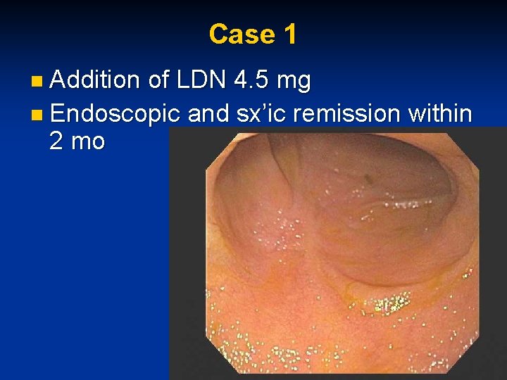 Case 1 n Addition of LDN 4. 5 mg n Endoscopic and sx’ic remission