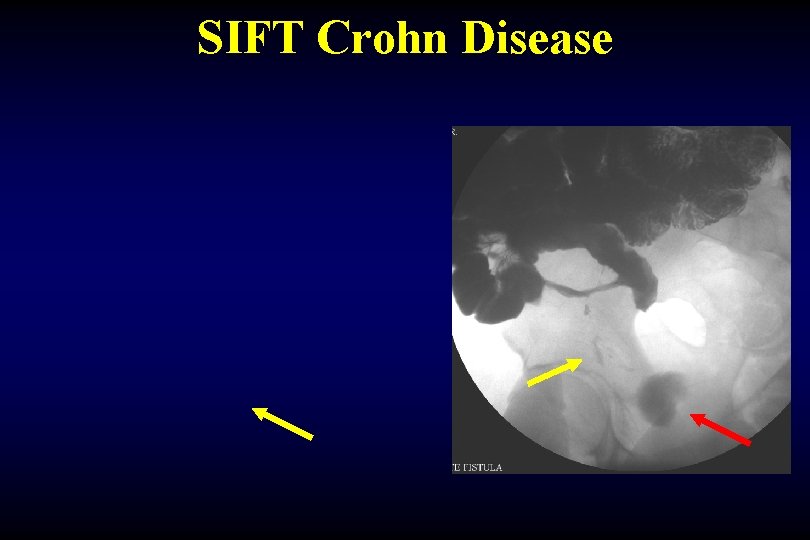 SIFT Crohn Disease 