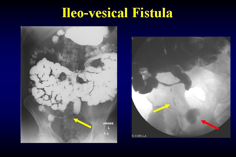 Ileo-vesical Fistula 