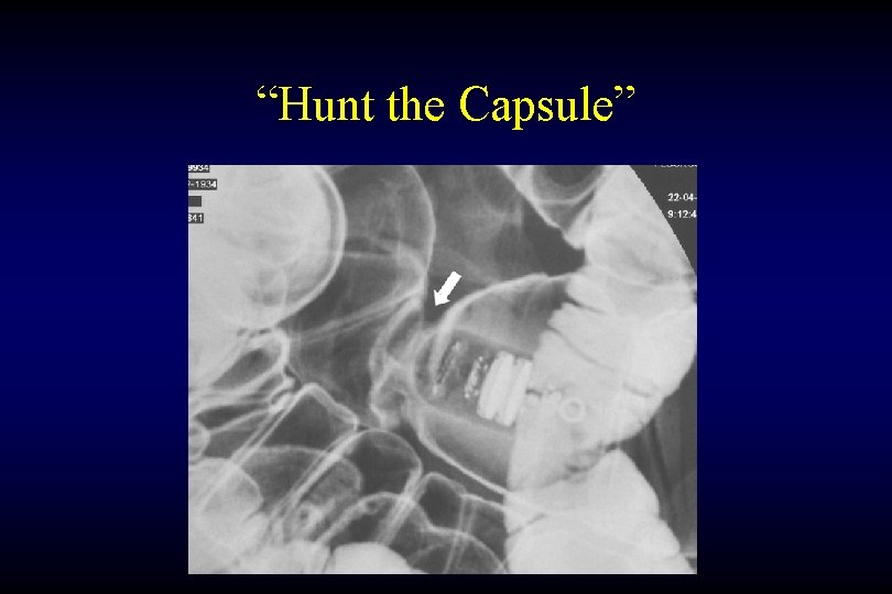 “Hunt the Capsule” 