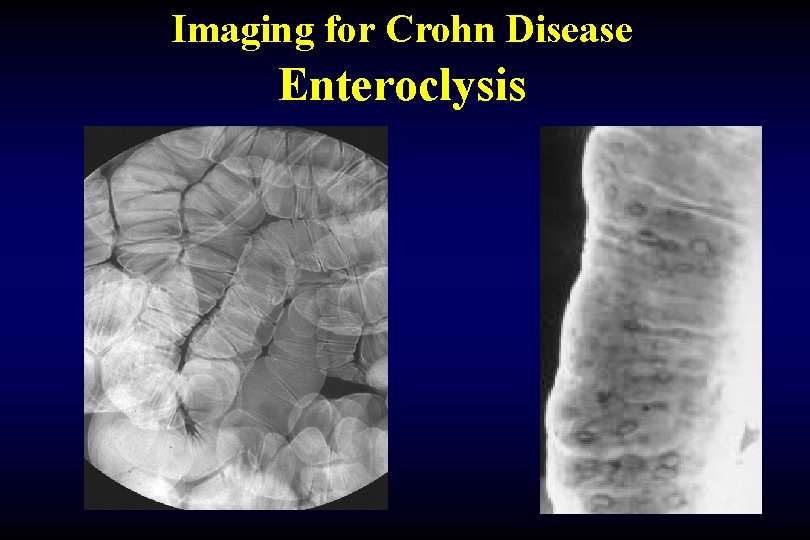 Imaging for Crohn Disease Enteroclysis 