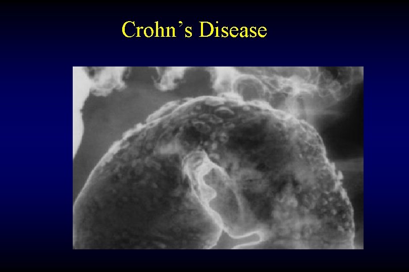Crohn’s Disease 