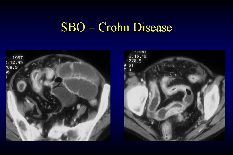 SBO – Crohn Disease 