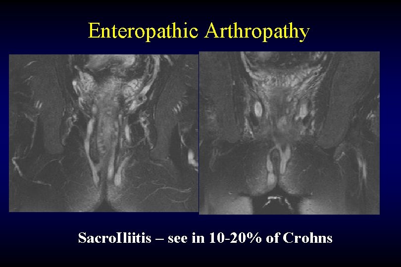 Enteropathic Arthropathy Sacro. Iliitis – see in 10 -20% of Crohns 
