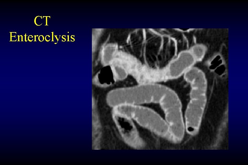 CT Enteroclysis 