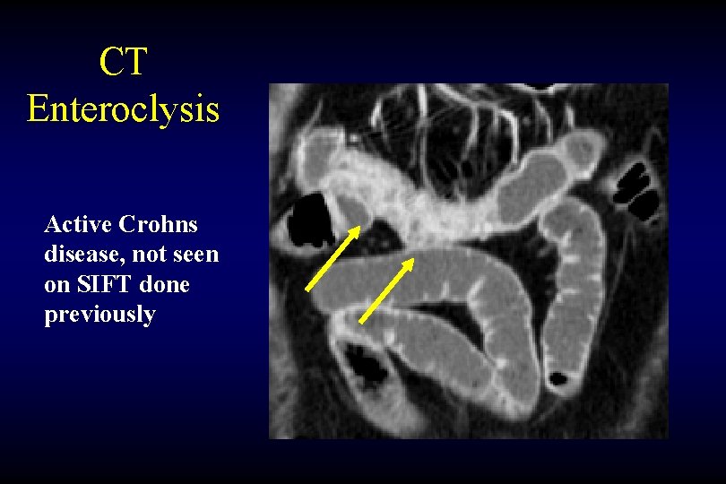 CT Enteroclysis Active Crohns disease, not seen on SIFT done previously 