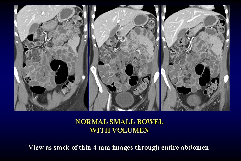 NORMAL SMALL BOWEL WITH VOLUMEN View as stack of thin 4 mm images through