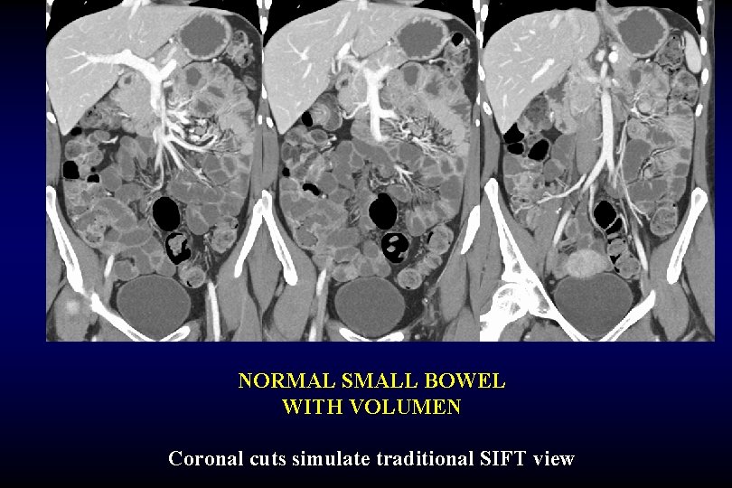 NORMAL SMALL BOWEL WITH VOLUMEN Coronal cuts simulate traditional SIFT view 