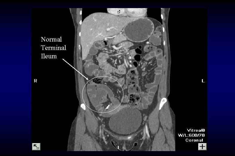 Normal Terminal Ileum 