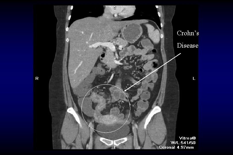 Crohn’s Disease 