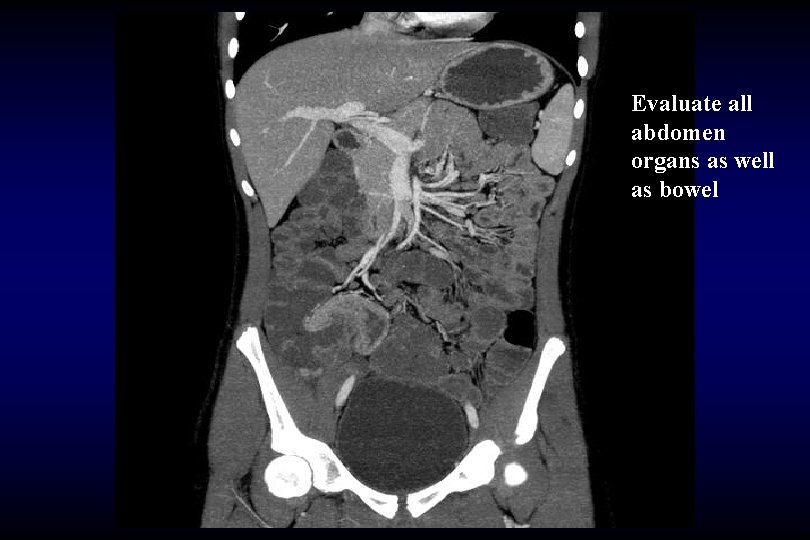 Evaluate all abdomen organs as well as bowel 