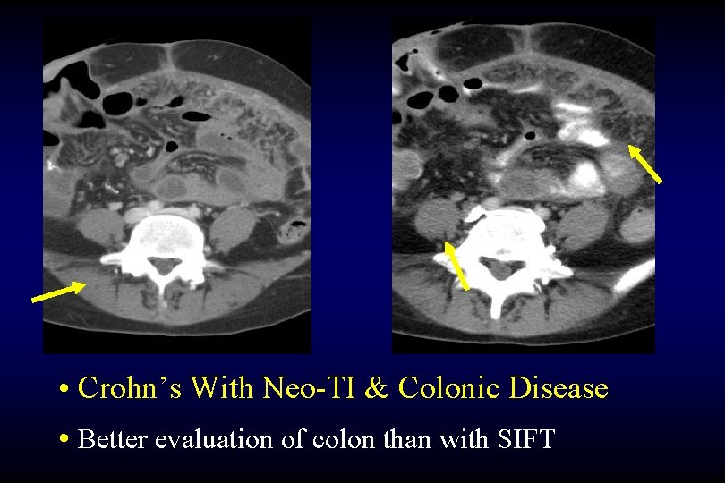  • Crohn’s With Neo-TI & Colonic Disease • Better evaluation of colon than