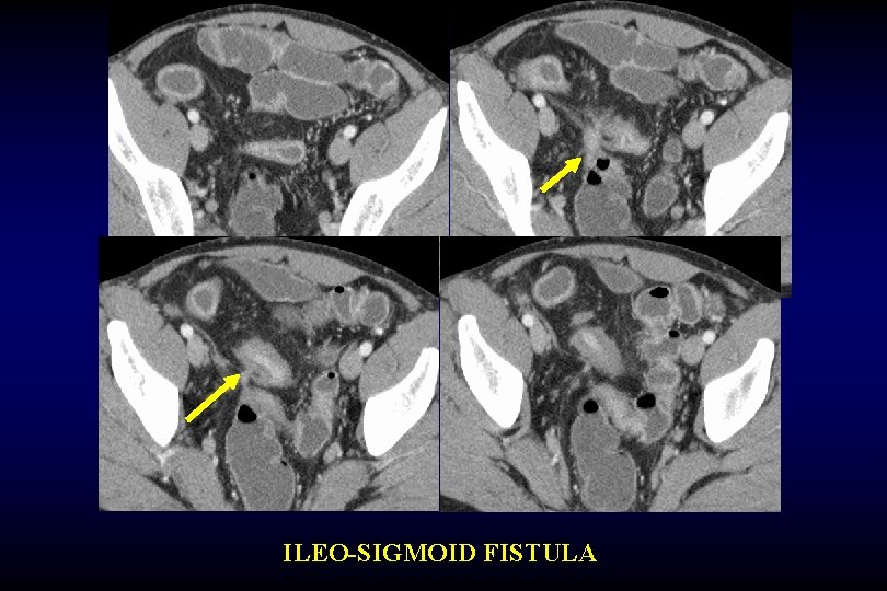 ILEO-SIGMOID FISTULA 