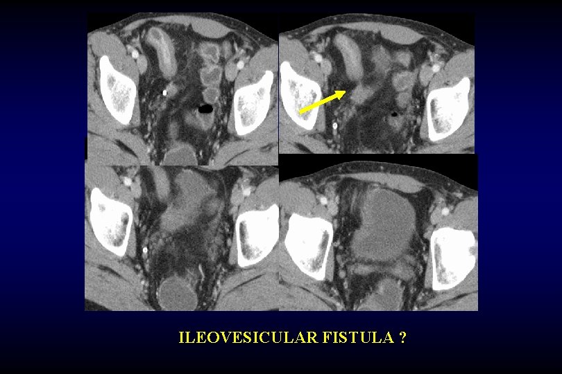 ILEOVESICULAR FISTULA ? 