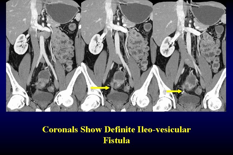 Coronals Show Definite Ileo-vesicular Fistula 