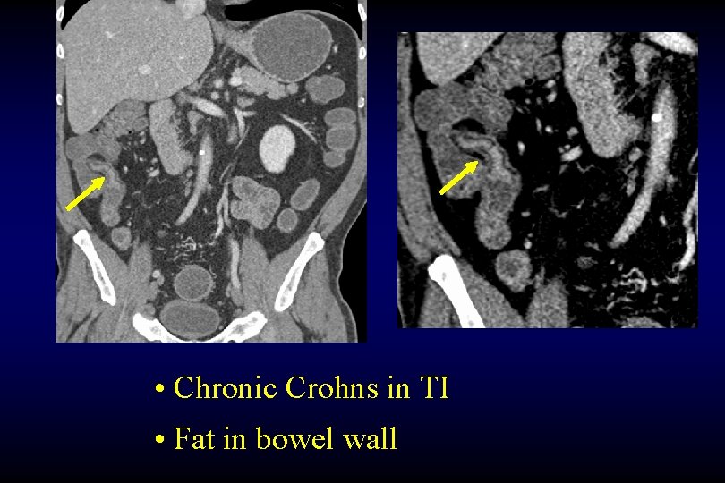  • Chronic Crohns in TI • Fat in bowel wall 