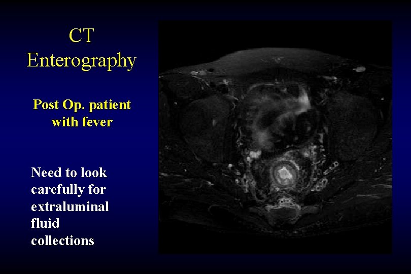 CT Enterography Post Op. patient with fever Need to look carefully for extraluminal fluid
