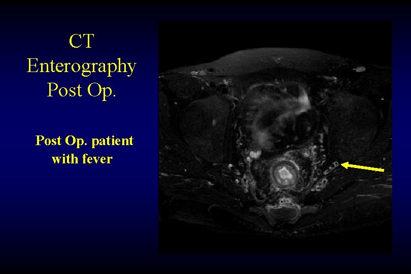 CT Enterography Post Op. patient with fever 