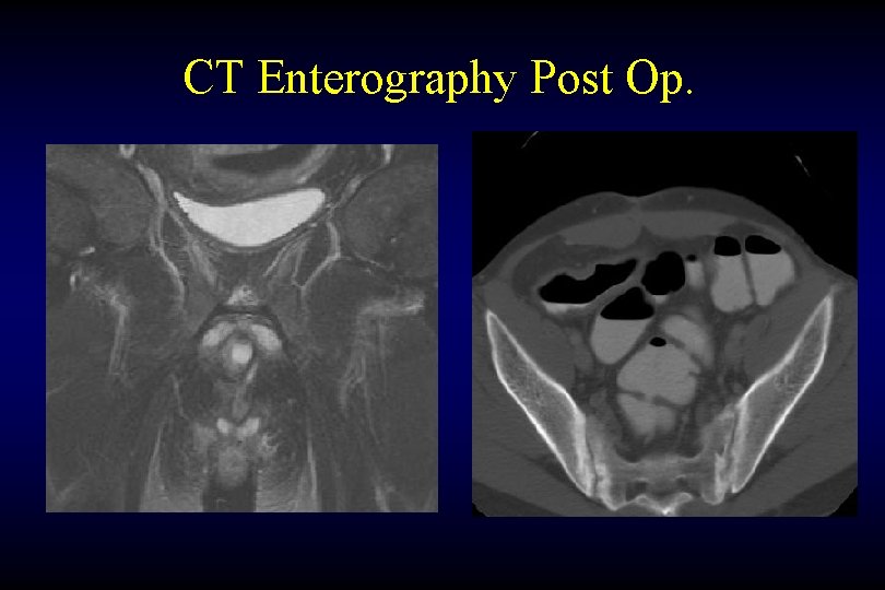 CT Enterography Post Op. 