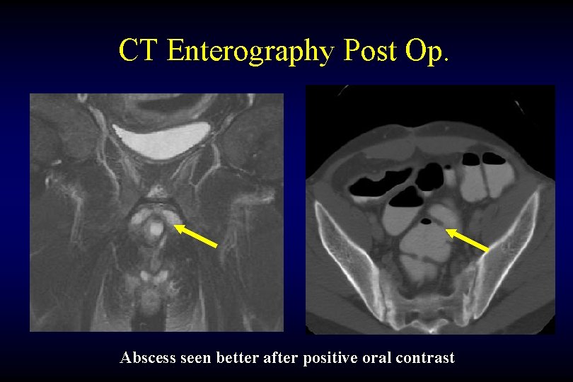CT Enterography Post Op. Abscess seen better after positive oral contrast 