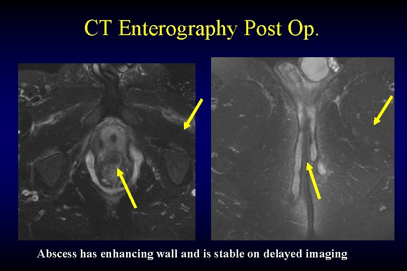 CT Enterography Post Op. Abscess has enhancing wall and is stable on delayed imaging