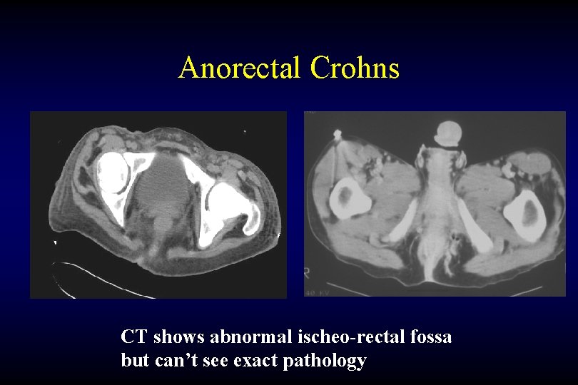 Anorectal Crohns CT shows abnormal ischeo-rectal fossa but can’t see exact pathology 