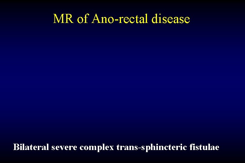 MR of Ano-rectal disease Bilateral severe complex trans-sphincteric fistulae 