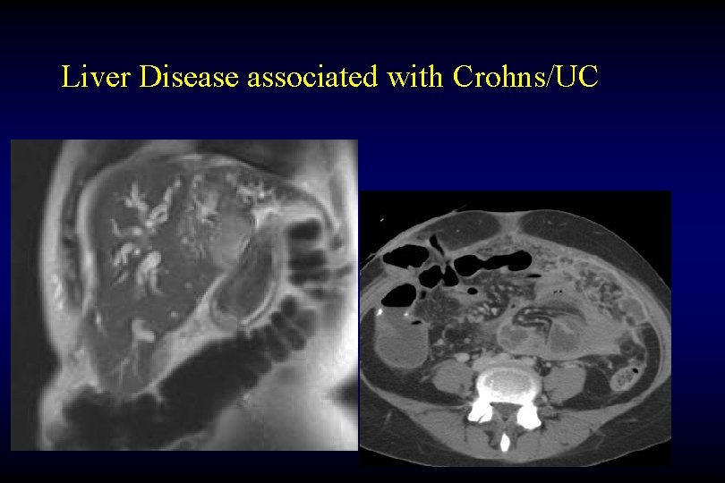 Liver Disease associated with Crohns/UC 