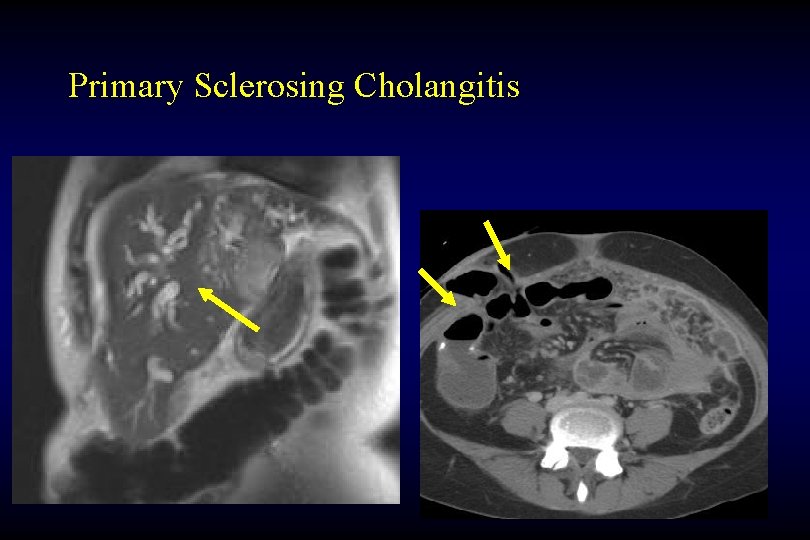 Primary Sclerosing Cholangitis 