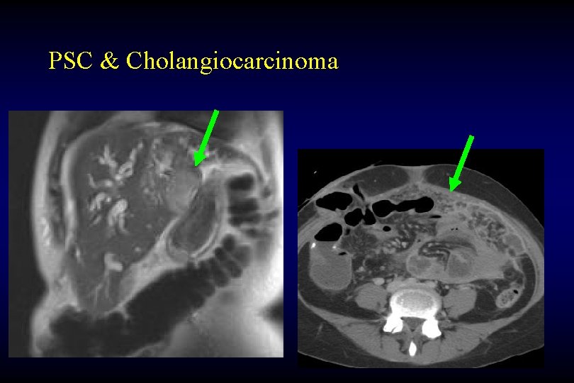 PSC & Cholangiocarcinoma 