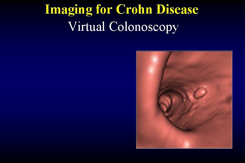 Imaging for Crohn Disease Virtual Colonoscopy 