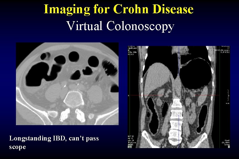 Imaging for Crohn Disease Virtual Colonoscopy Longstanding IBD, can’t pass scope 