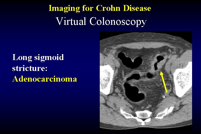 Imaging for Crohn Disease Virtual Colonoscopy Long sigmoid stricture: Adenocarcinoma 