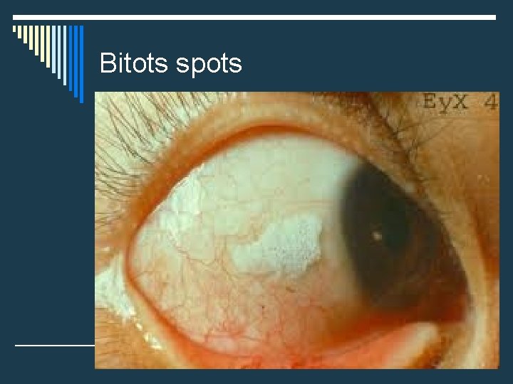 Bitots spots Bitots spots