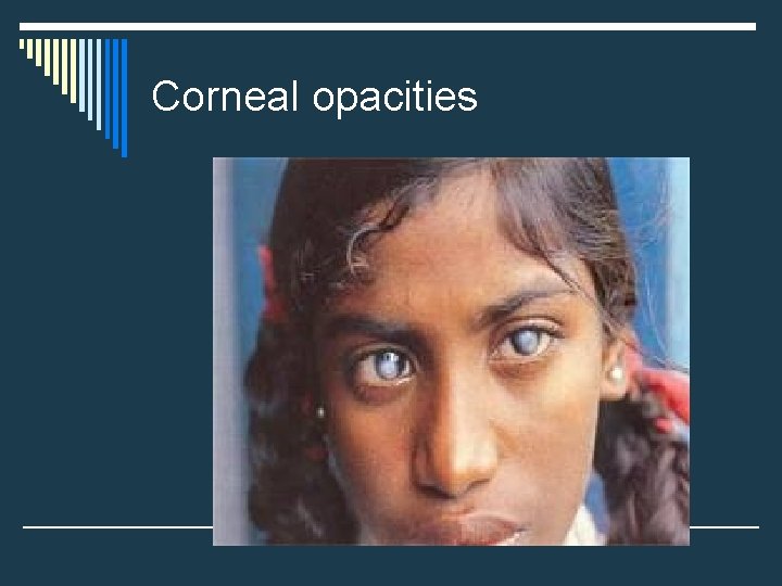 Corneal opacities 