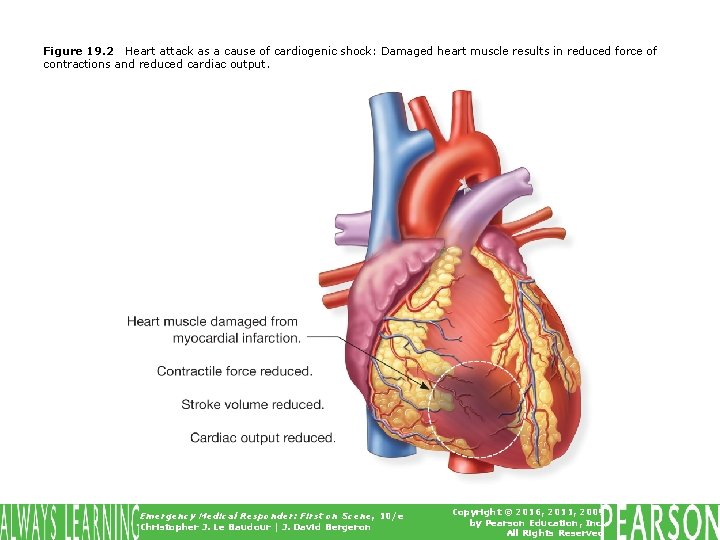 Figure 19. 2 Heart attack as a cause of cardiogenic shock: Damaged heart muscle