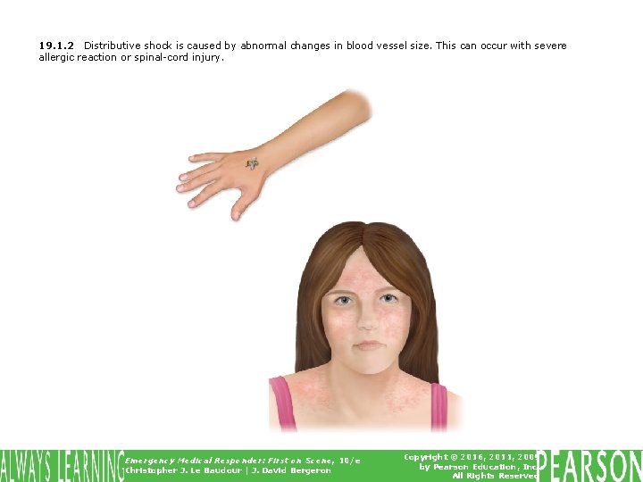 19. 1. 2 Distributive shock is caused by abnormal changes in blood vessel size.